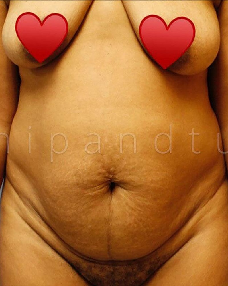 Abdominoplasty Before & After
