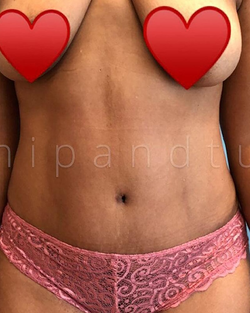 Abdominoplasty Before & After