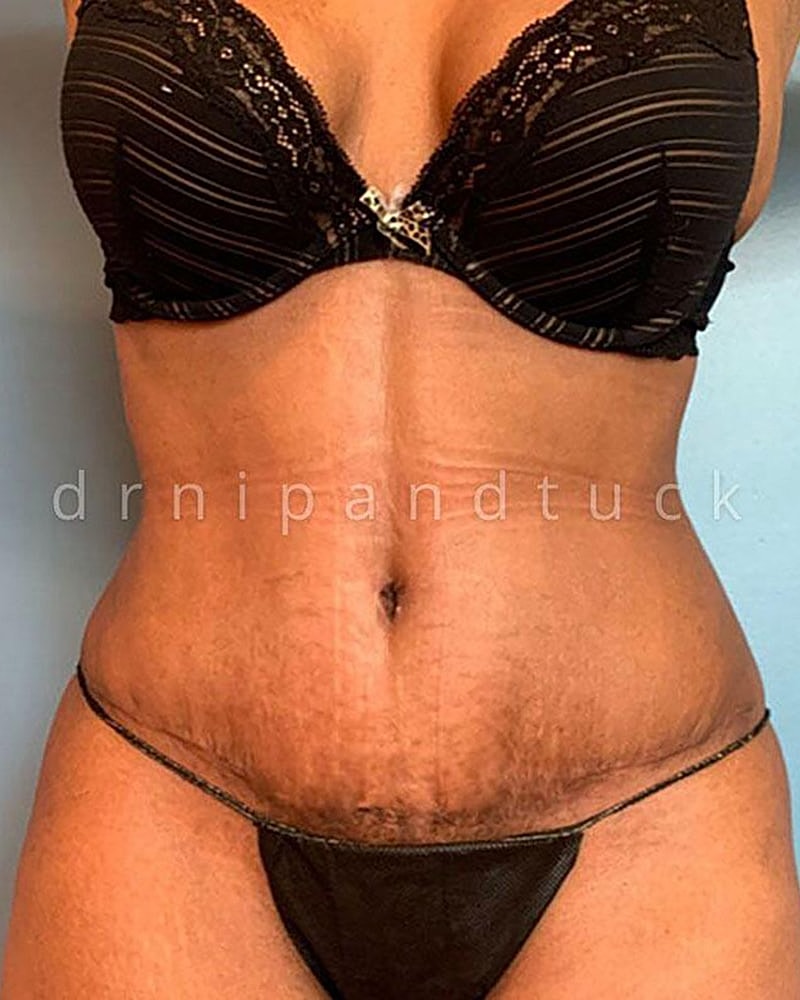 Abdominoplasty Before & After