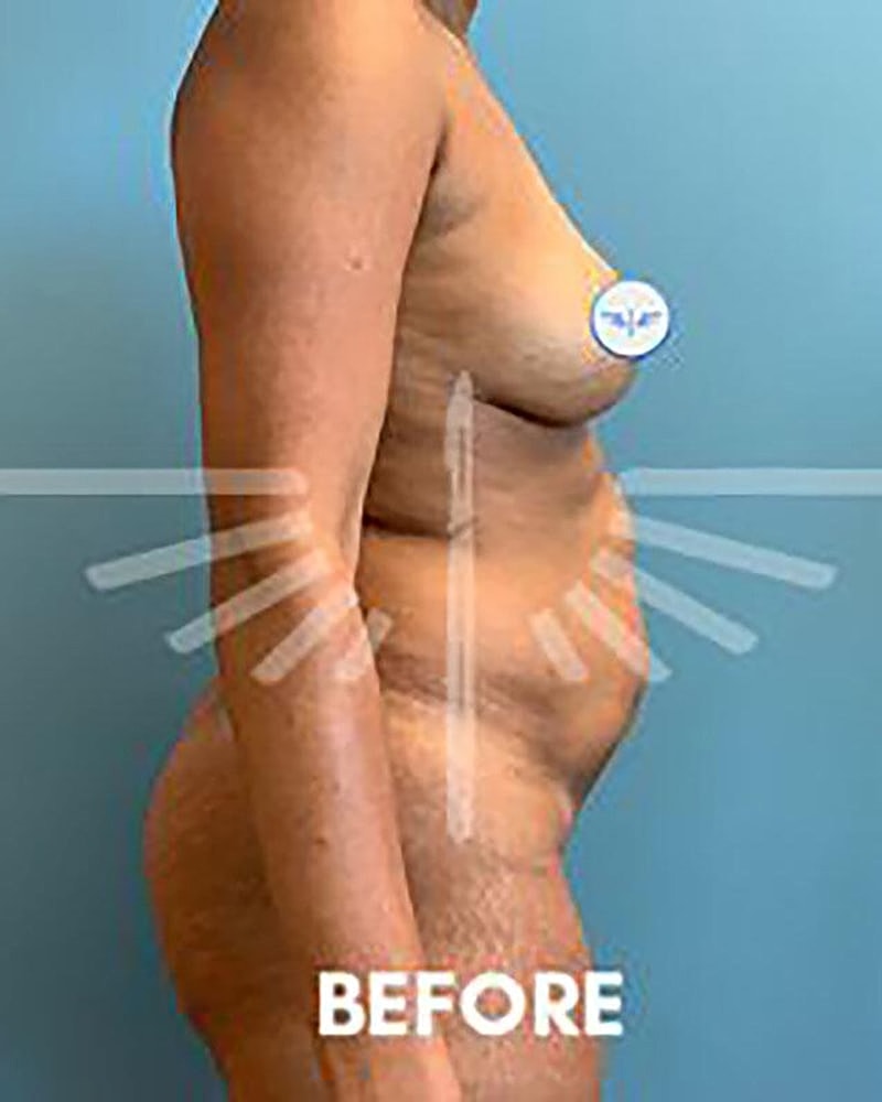 Abdominoplasty Before & After