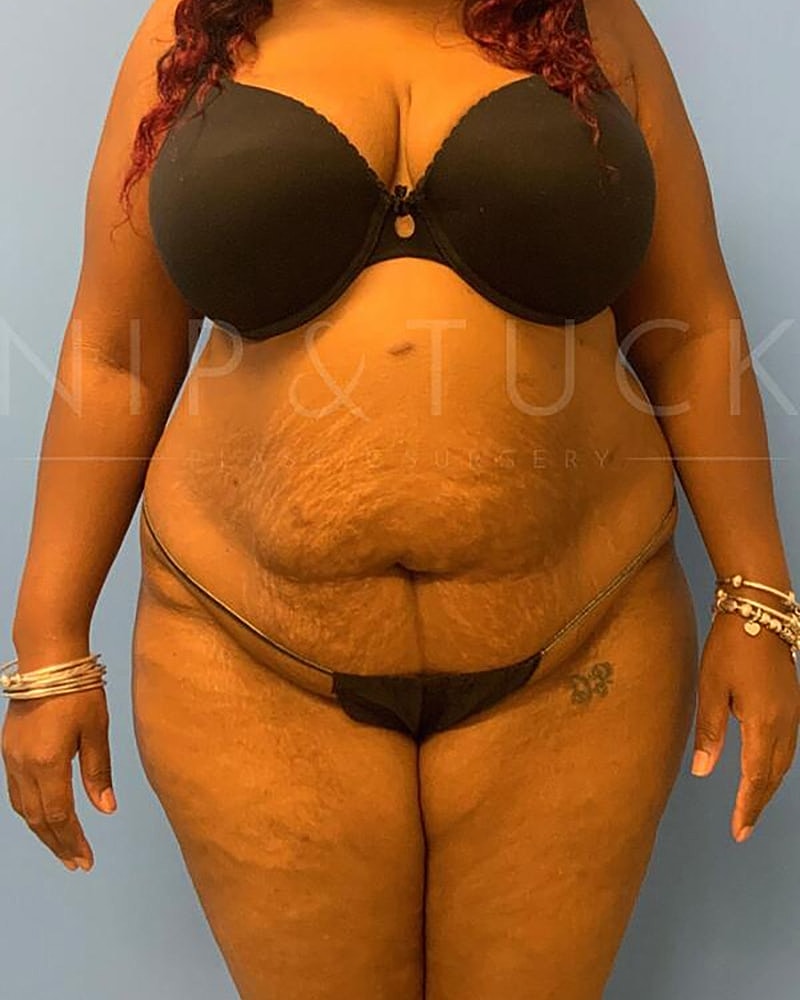 Abdominoplasty Before & After