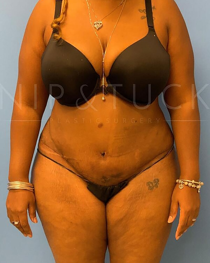 Abdominoplasty Before & After