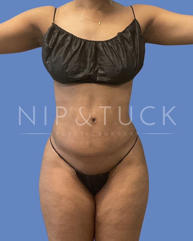 Abdominoplasty Before & After
