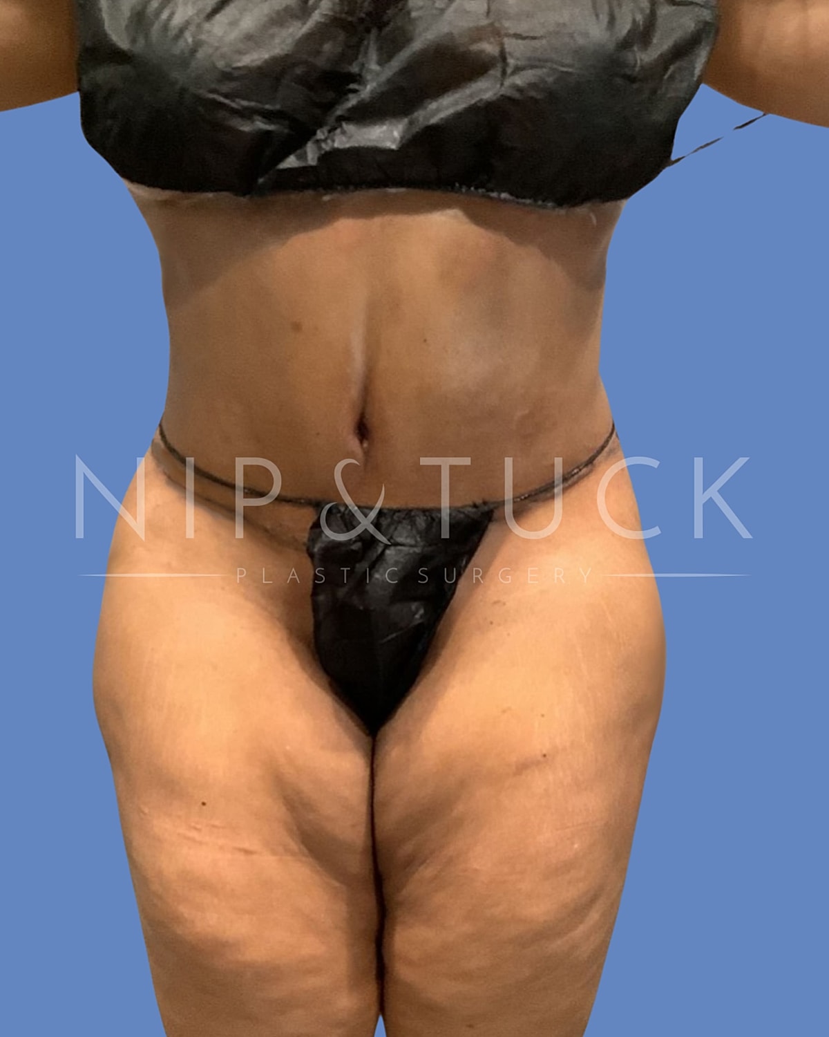 Abdominoplasty Before & After