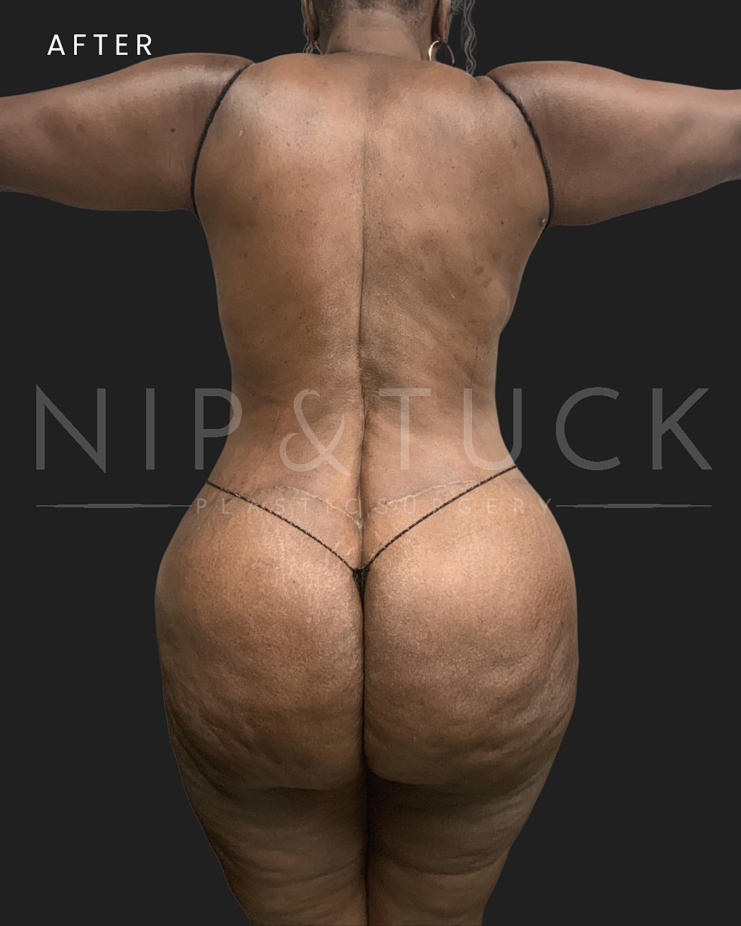 Abdominoplasty Before & After