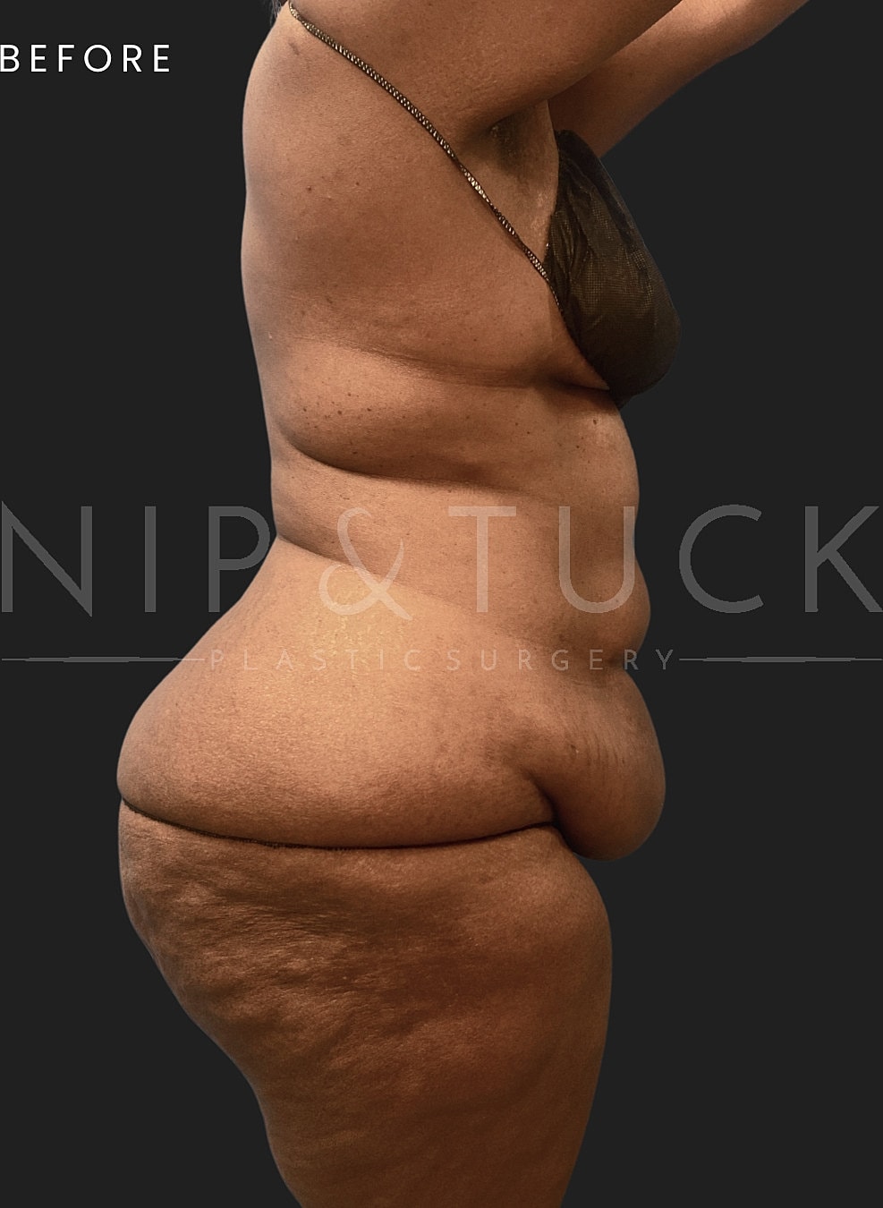 Abdominoplasty Before & After