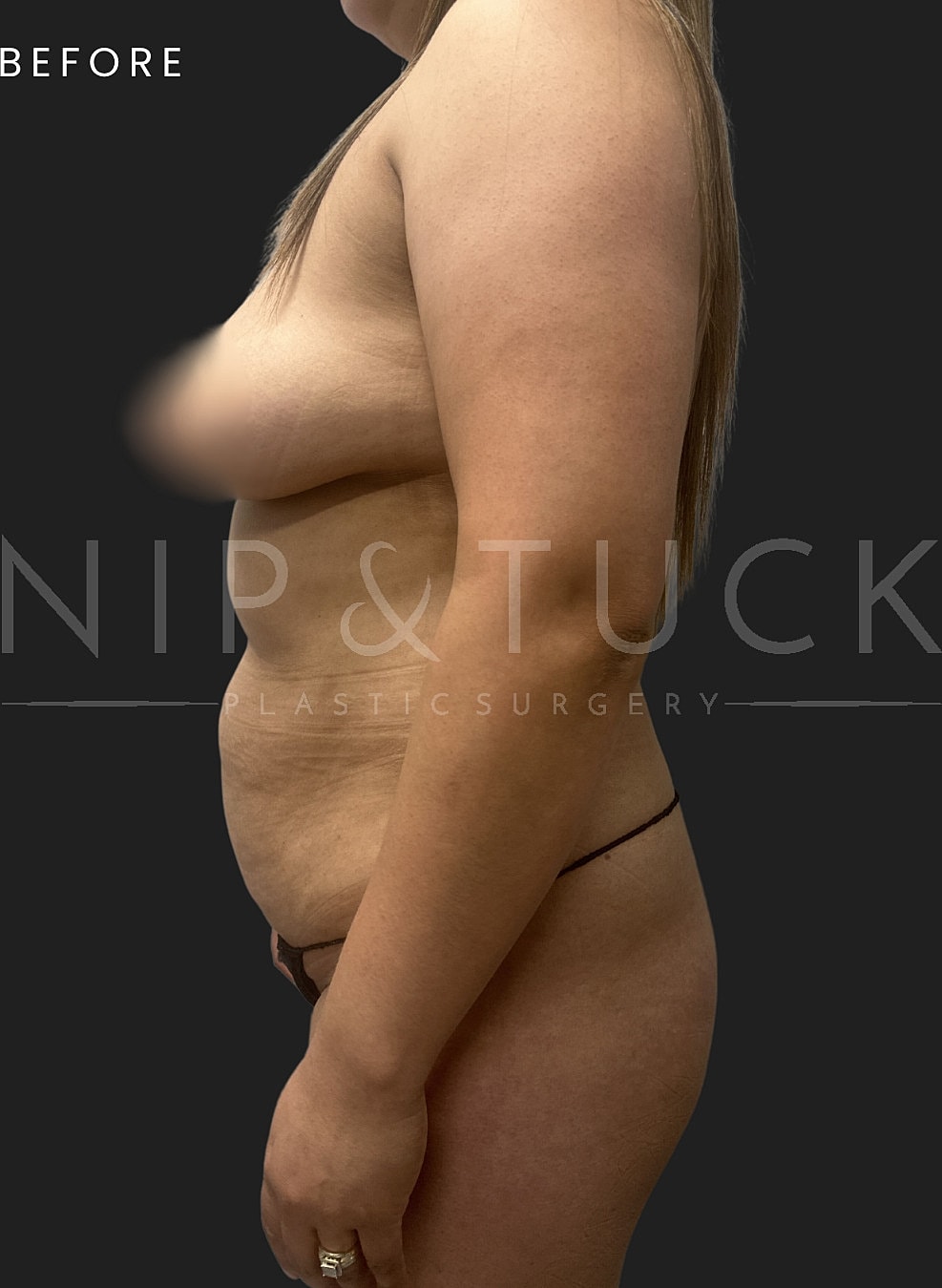 Abdominoplasty Before & After