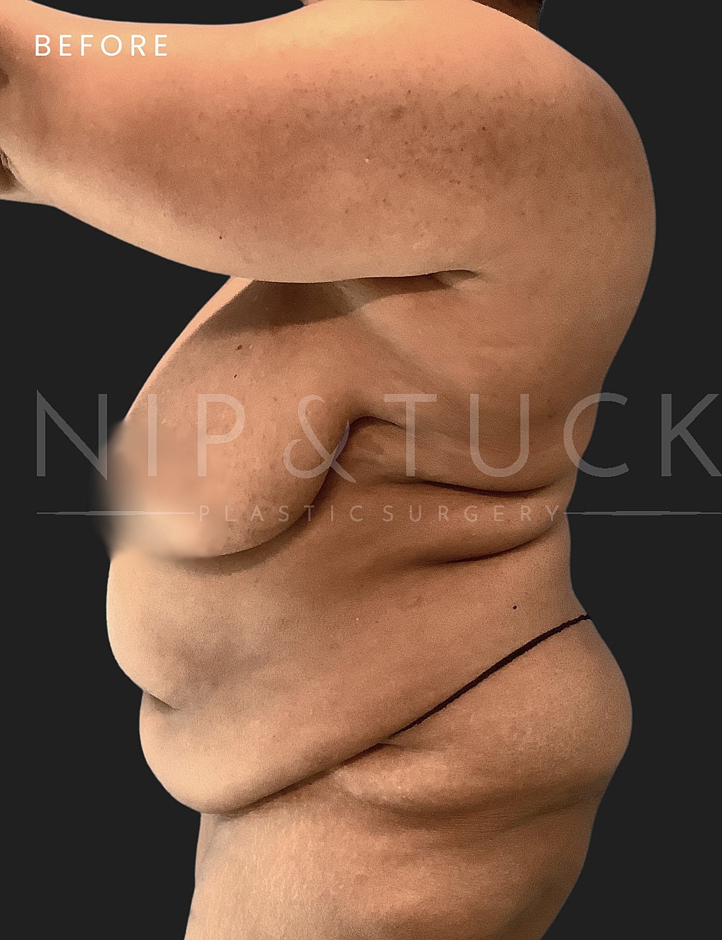 Abdominoplasty Before & After
