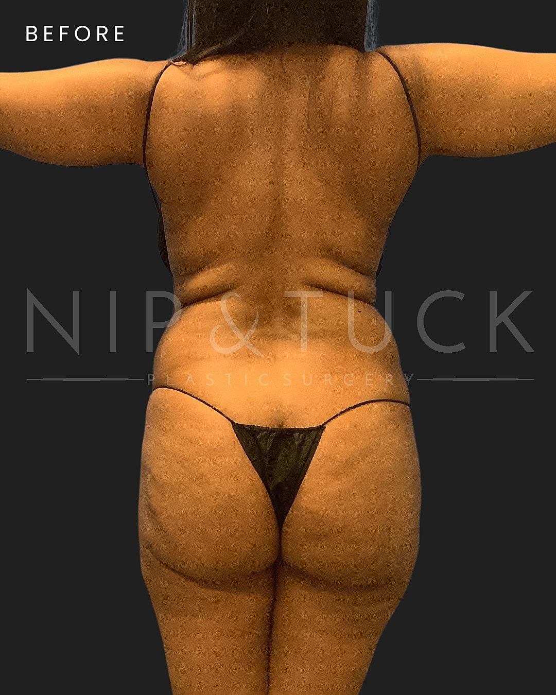 Abdominoplasty Before & After