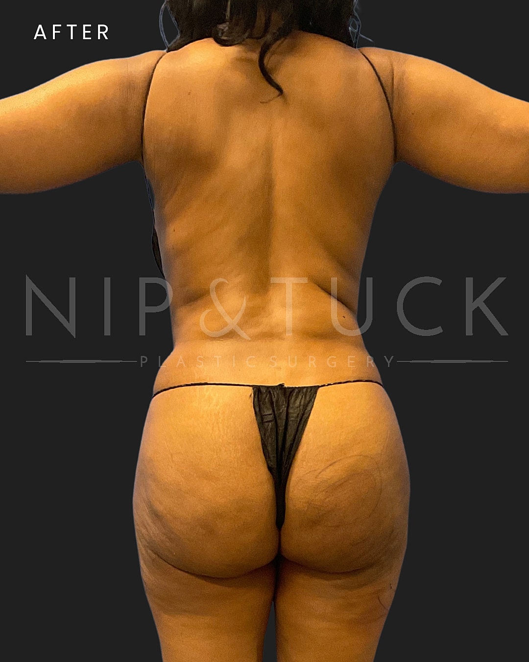 Abdominoplasty Before & After