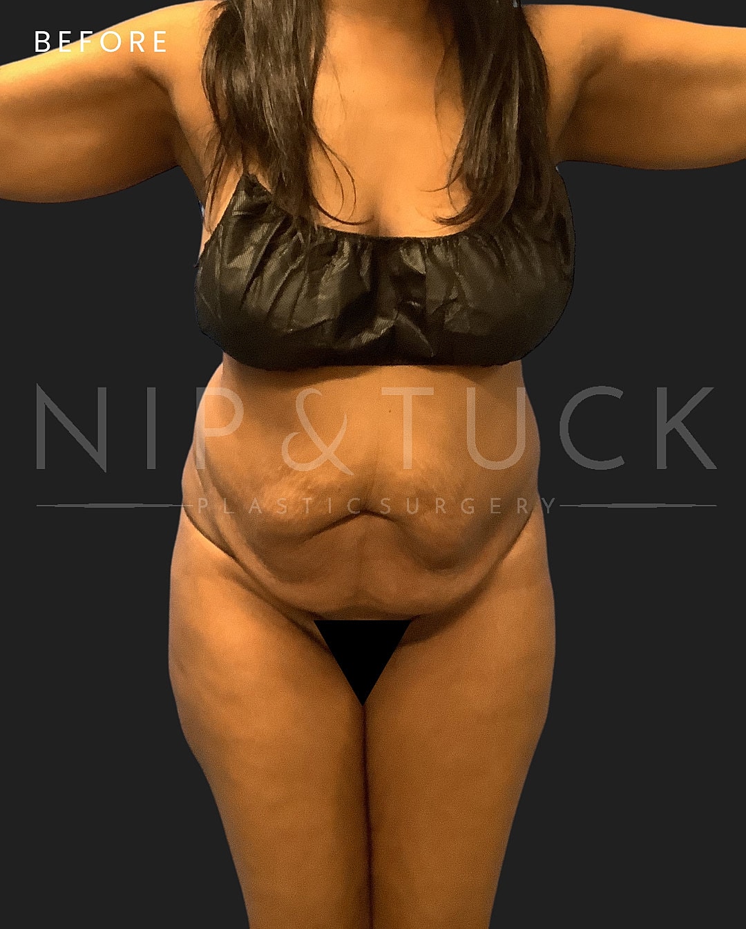 Abdominoplasty Before & After