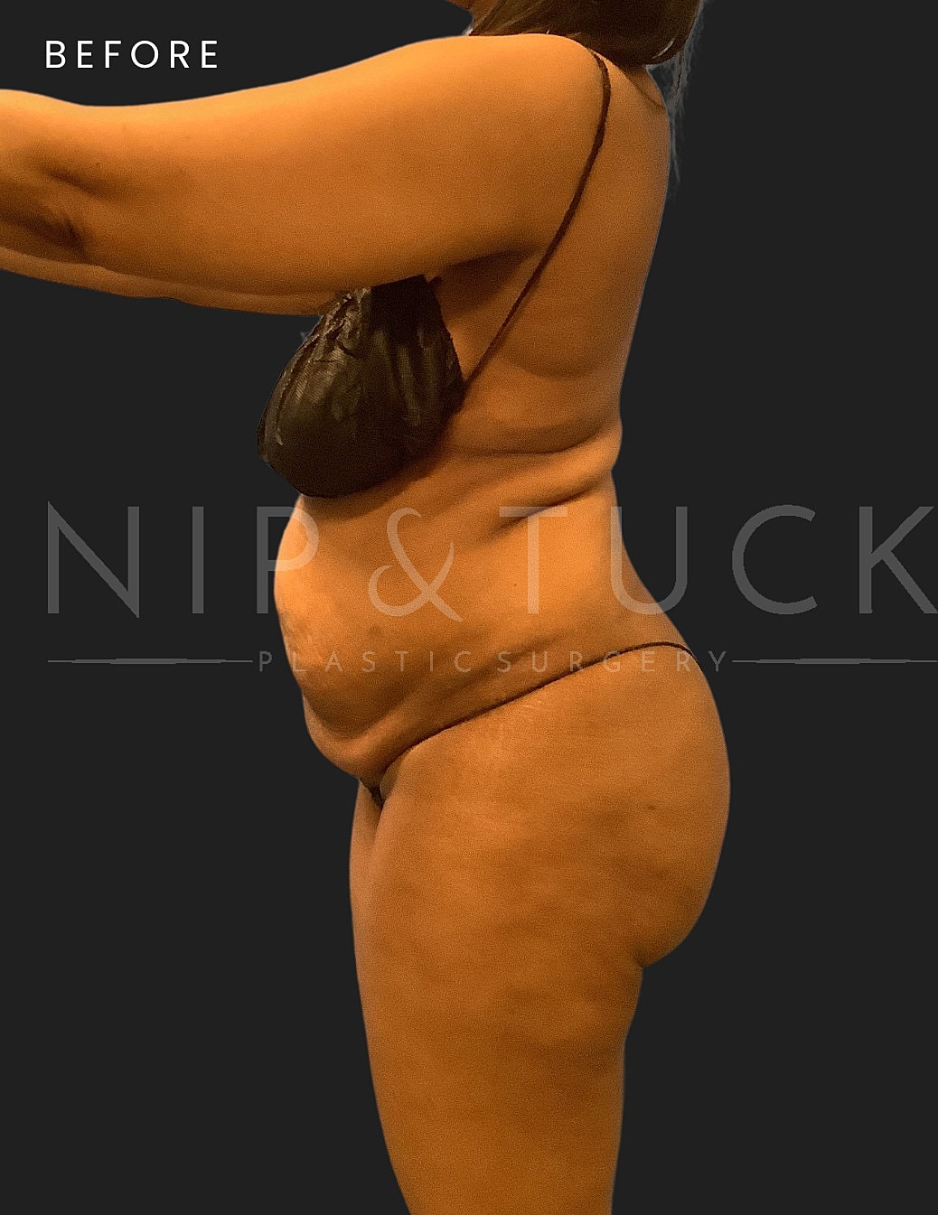 Abdominoplasty Before & After