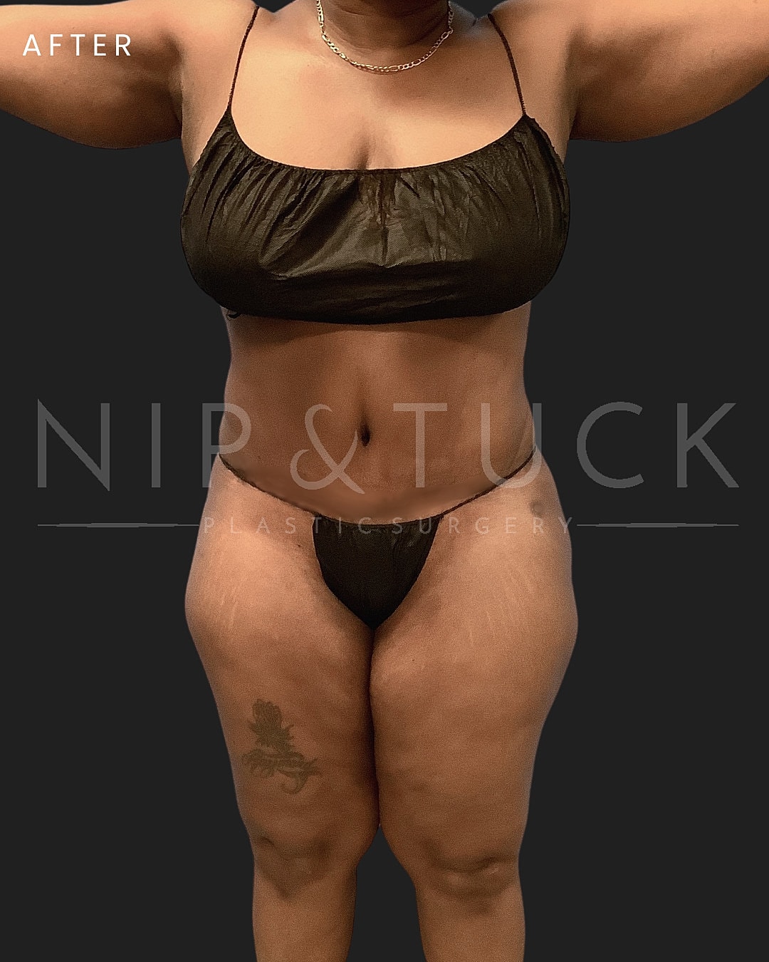 Abdominoplasty Before & After