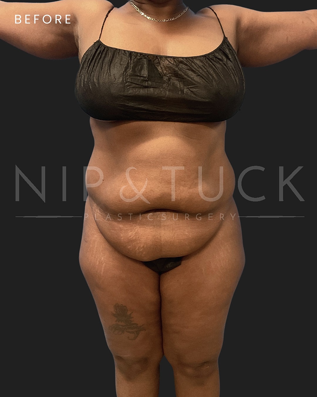 Abdominoplasty Before & After