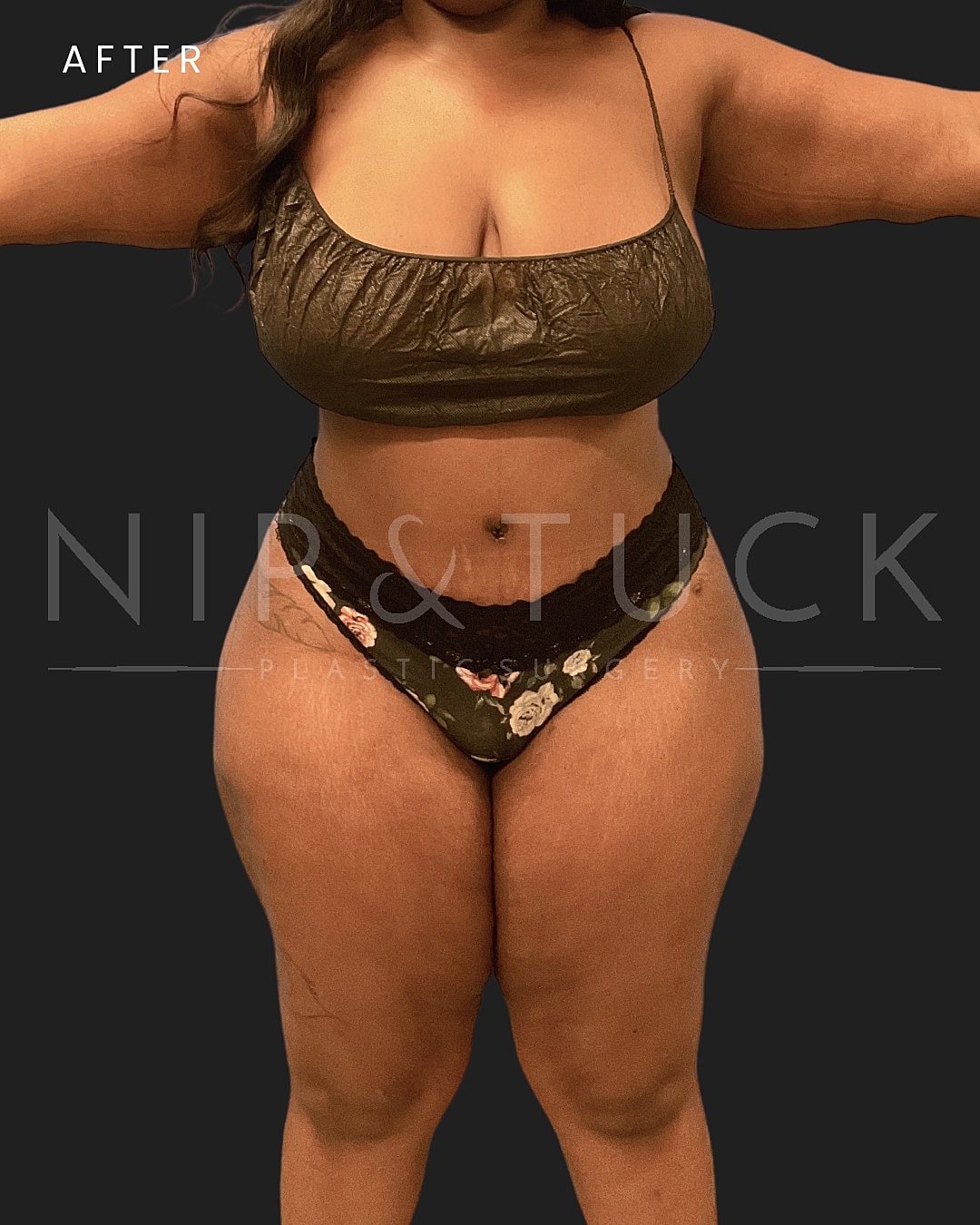 Abdominoplasty Before & After