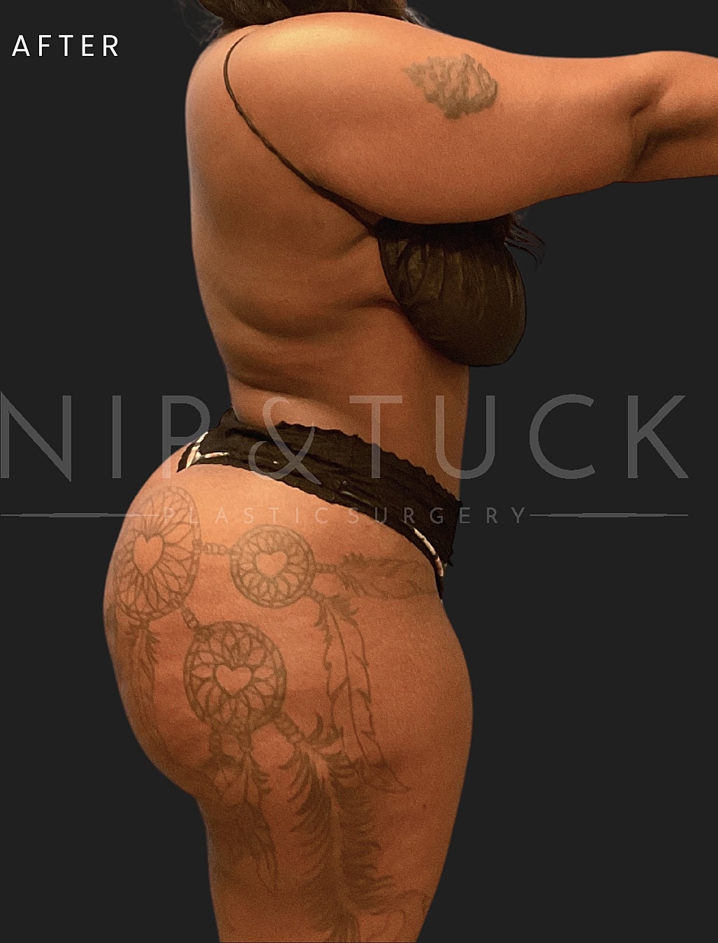Abdominoplasty Before & After