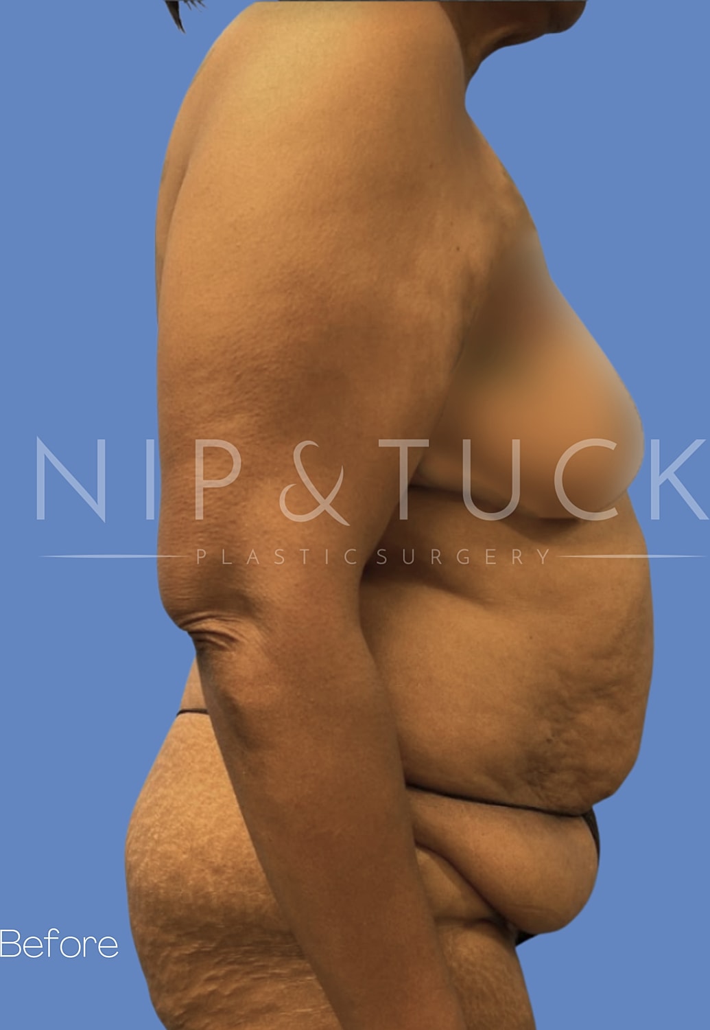 Abdominoplasty Before & After