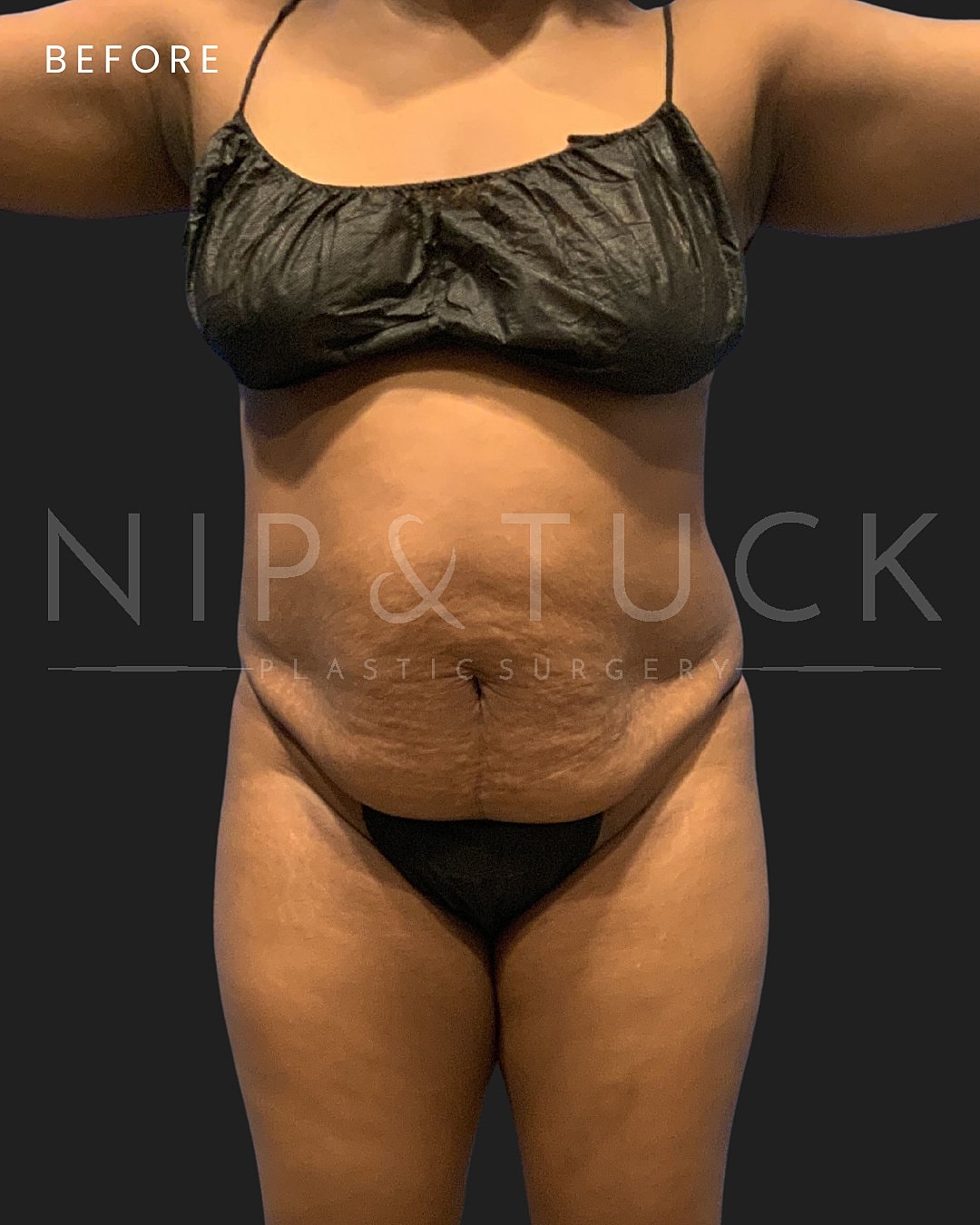Abdominoplasty Before & After
