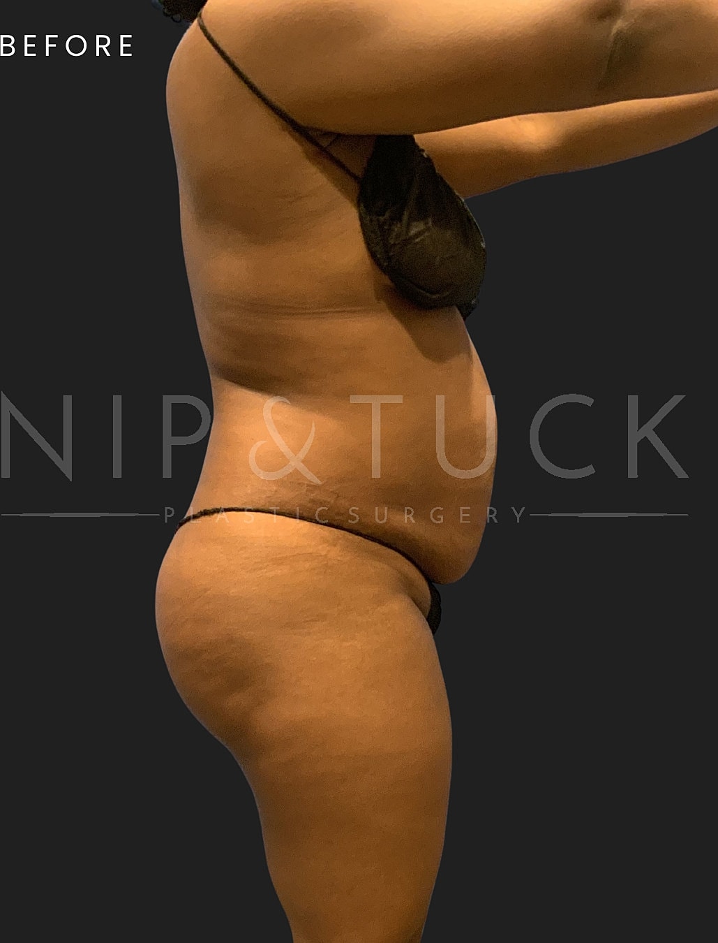 Abdominoplasty Before & After
