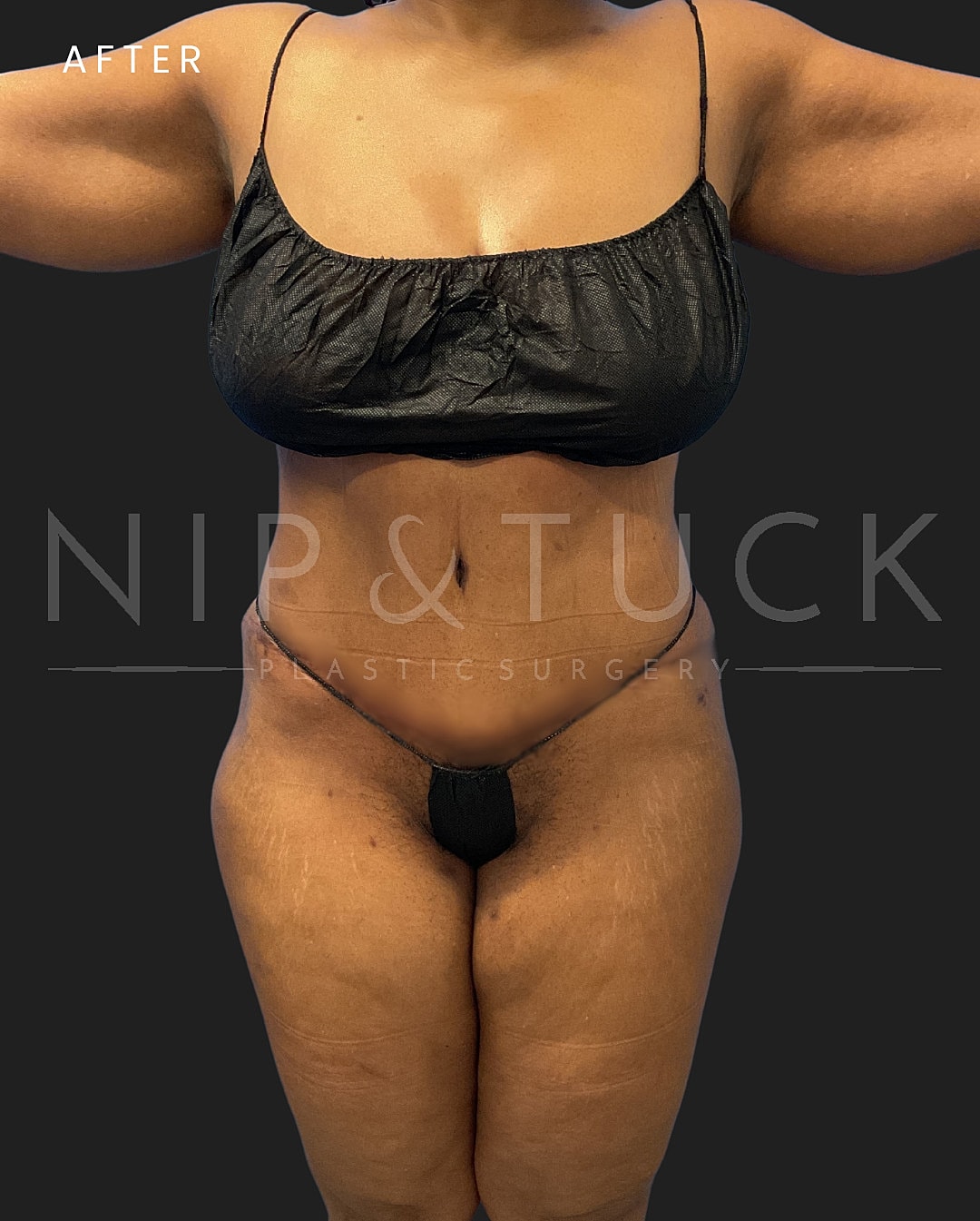 Abdominoplasty Before & After