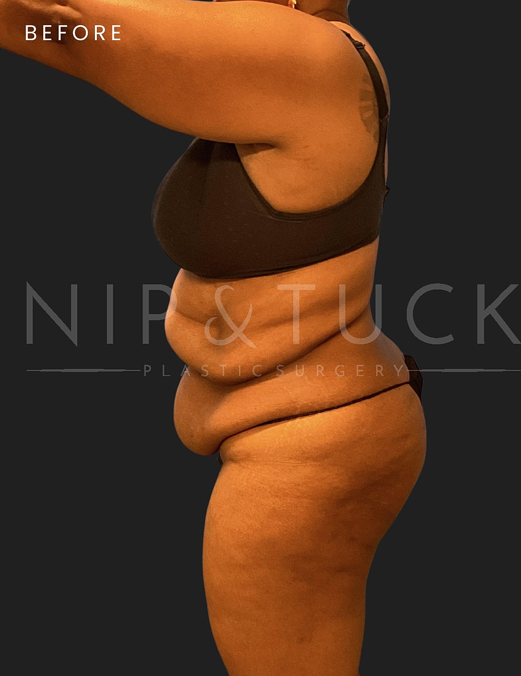 Abdominoplasty Before & After
