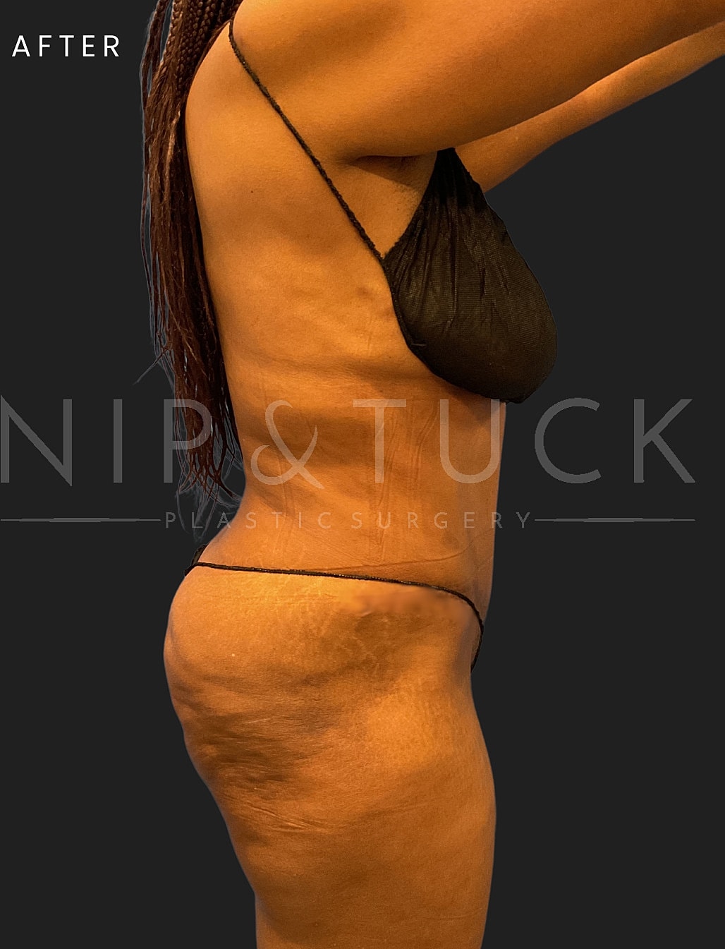 Abdominoplasty Before & After