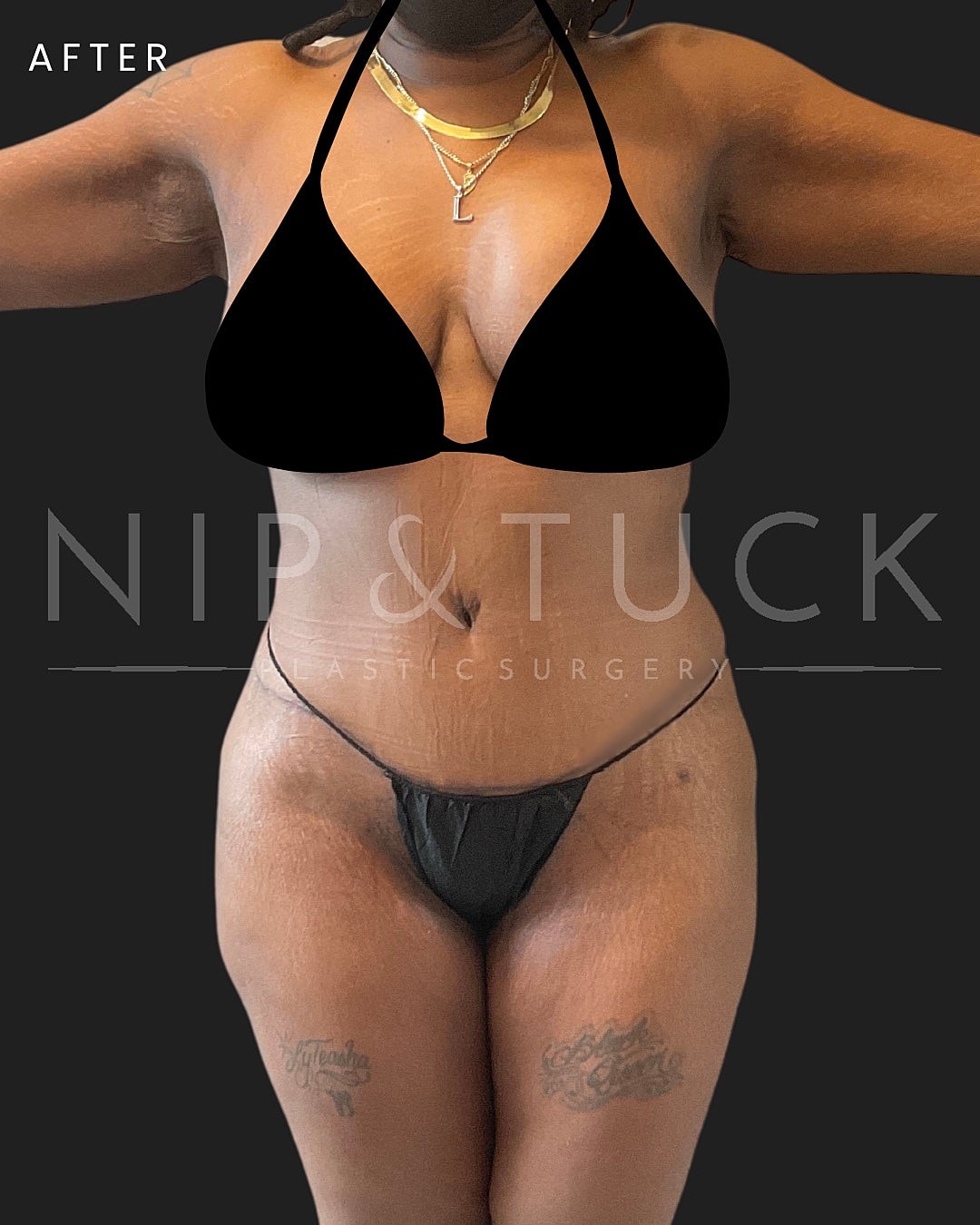 Abdominoplasty Before & After
