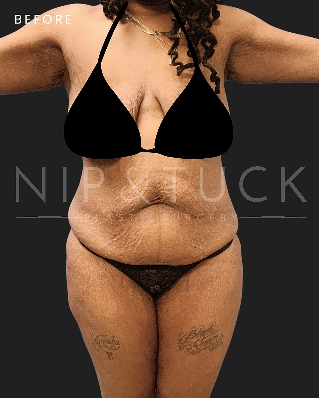 Abdominoplasty Before & After