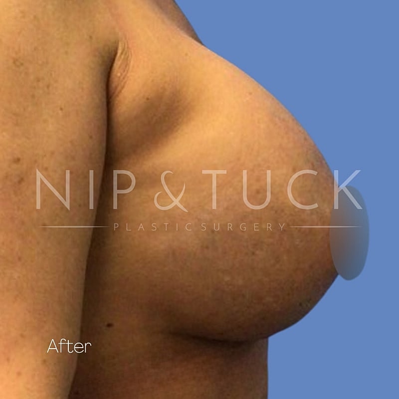 Breast Augmentation Before & After