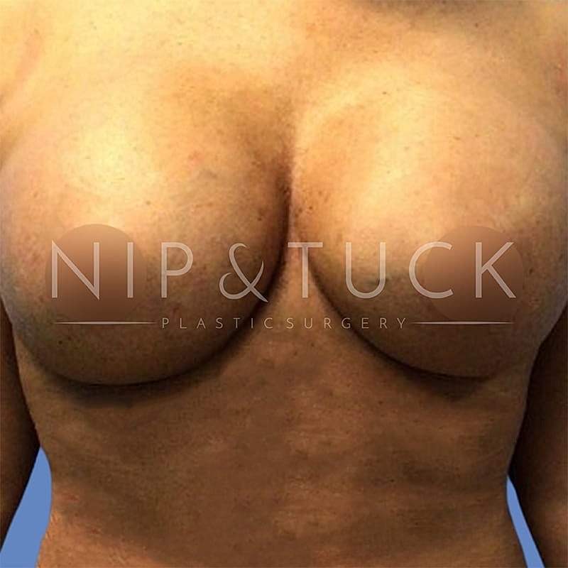 Breast Augmentation Before & After