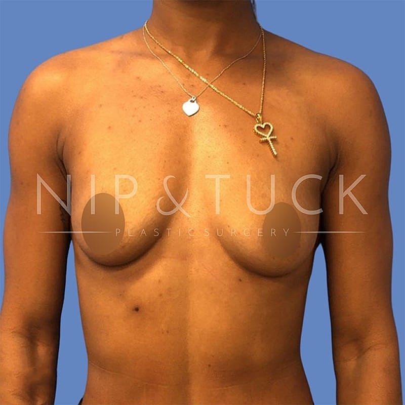 Breast Augmentation Before & After