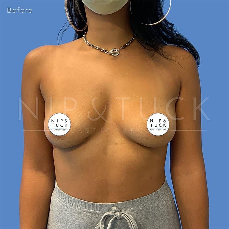 Breast Augmentation Before & After