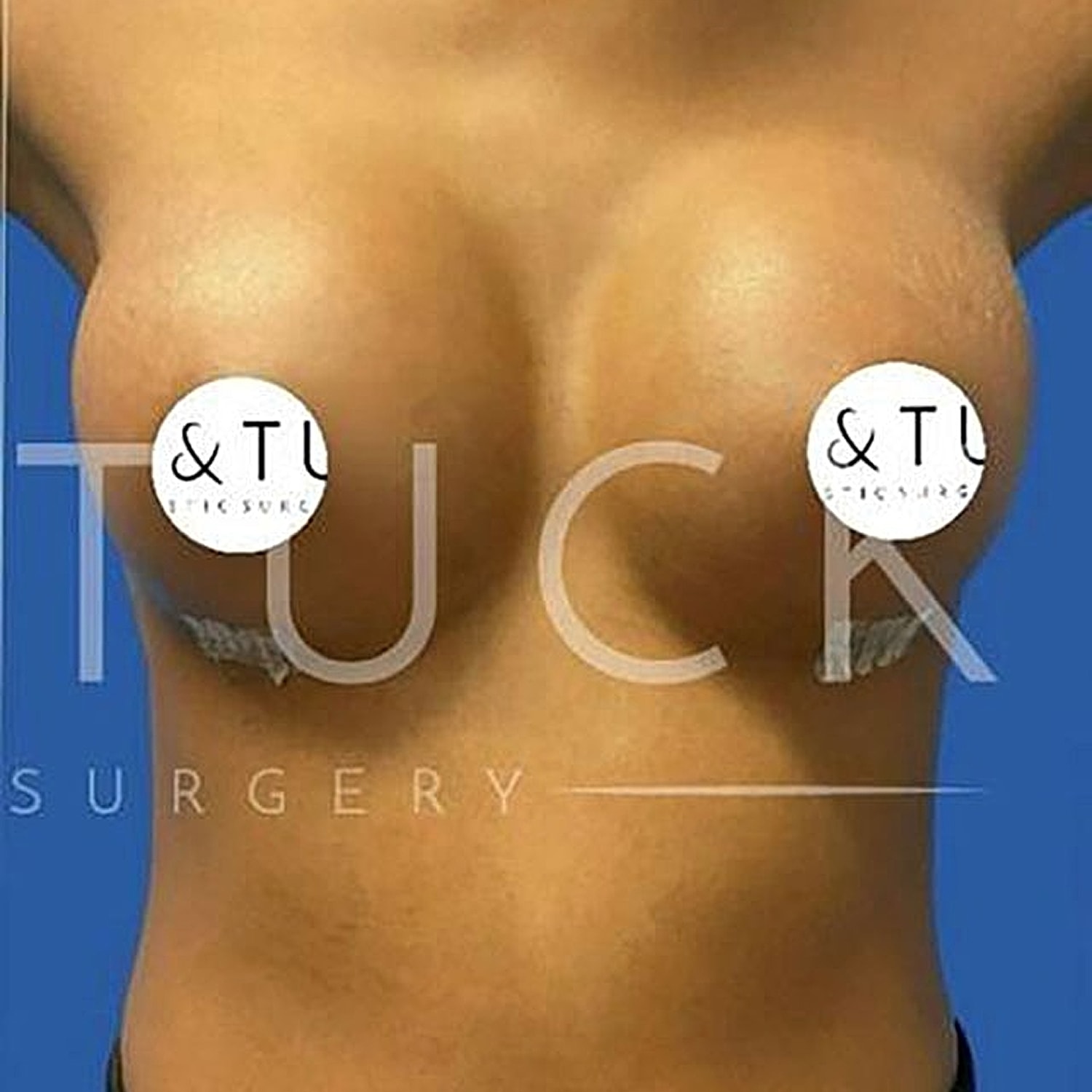 Breast Augmentation Before & After