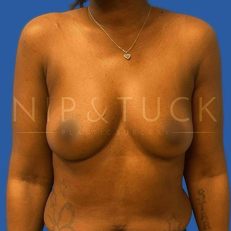 Breast Augmentation Before & After