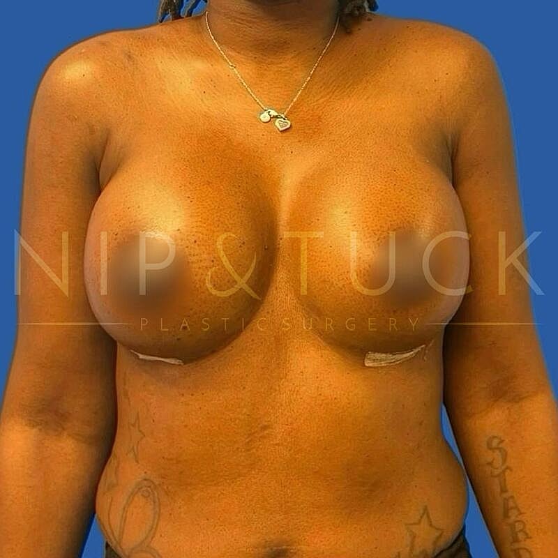 Breast Augmentation Before & After