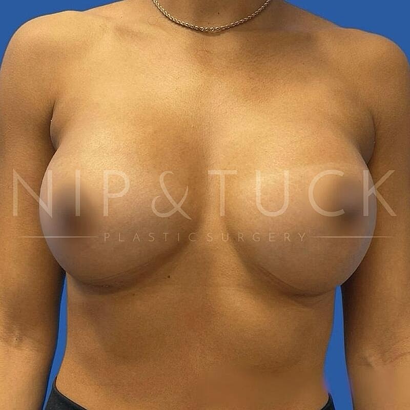 Breast Augmentation Before & After