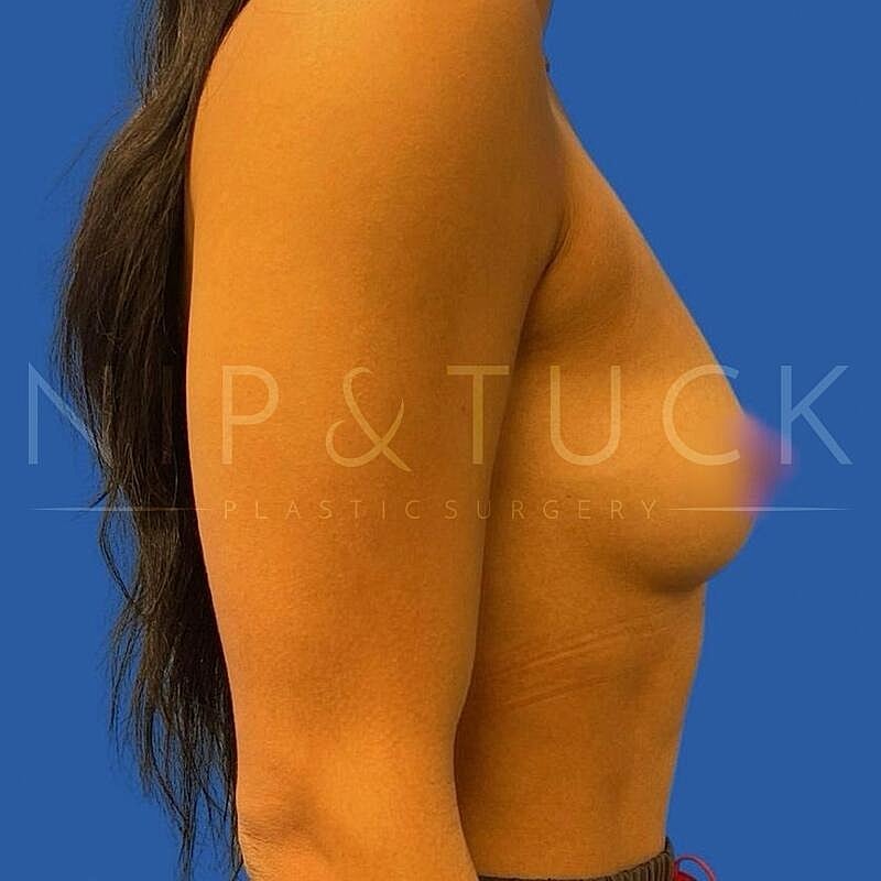Breast Augmentation Before & After
