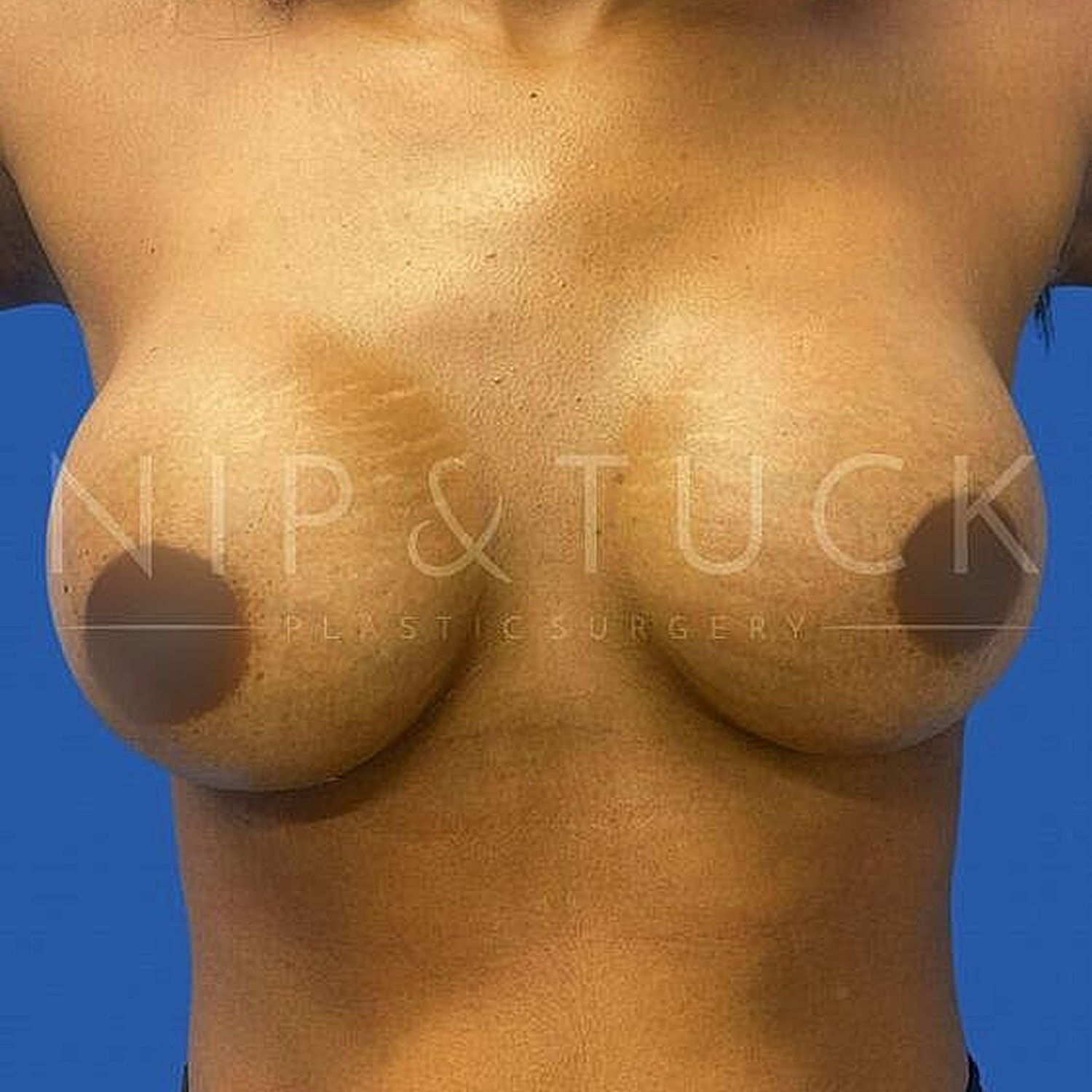 Breast Augmentation Before & After