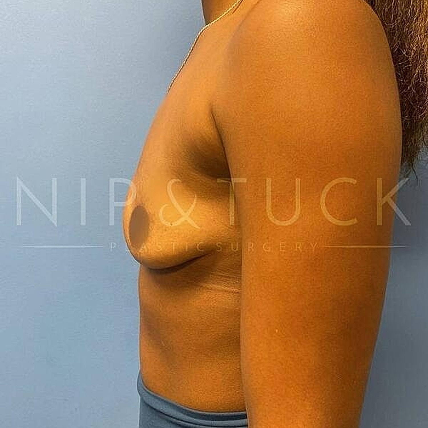 Breast Augmentation Before & After