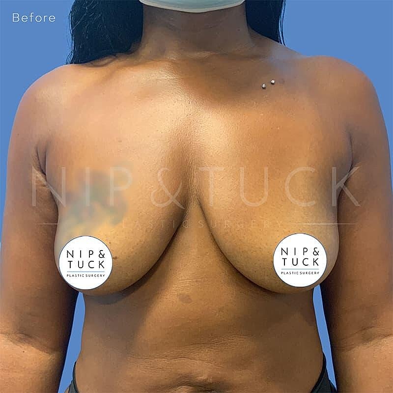 Breast Augmentation Before & After