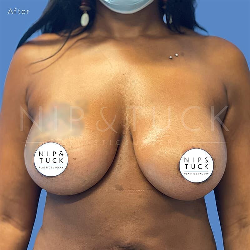 Breast Augmentation Before & After