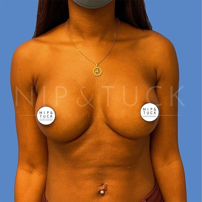 Breast Augmentation Before & After