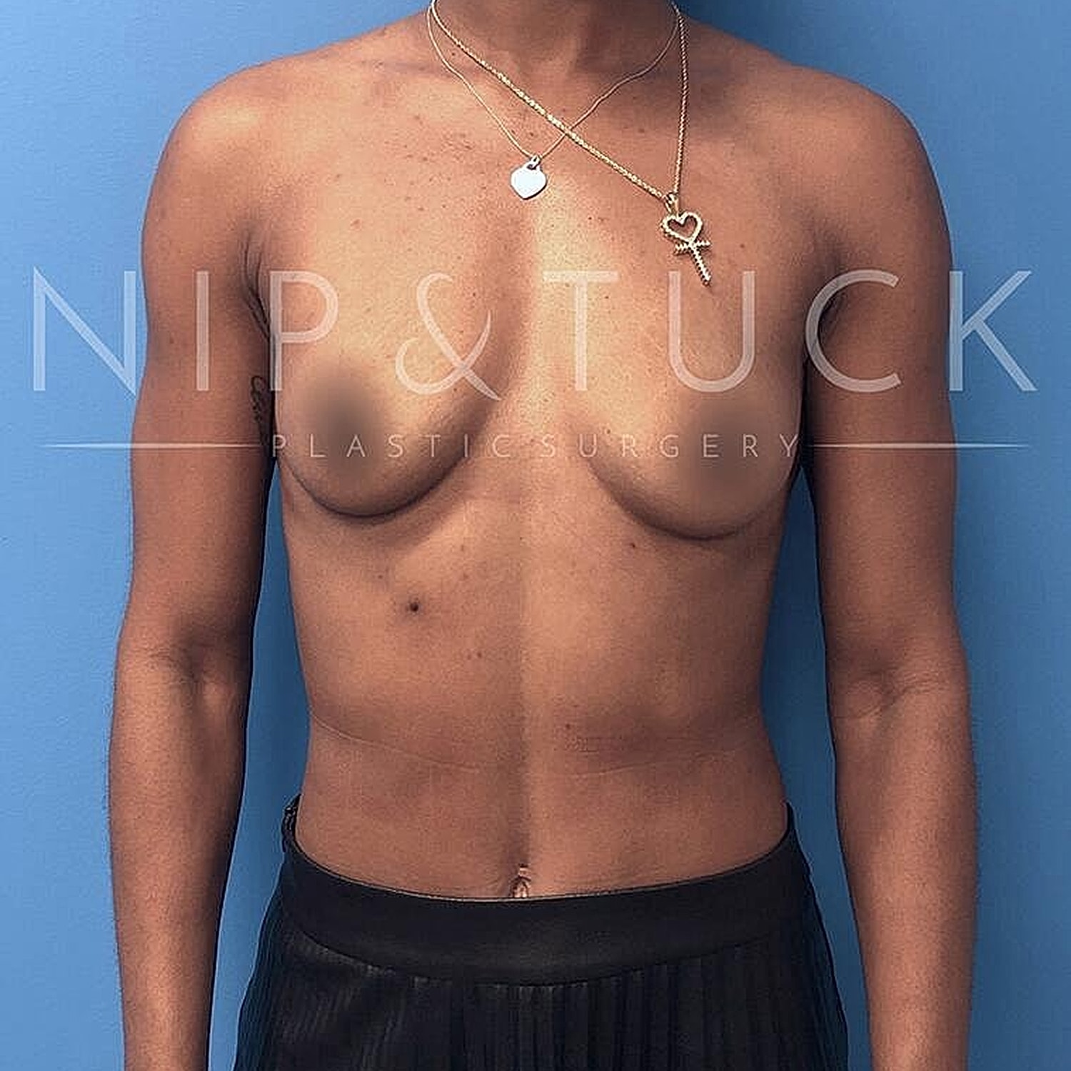 Breast Augmentation Before & After