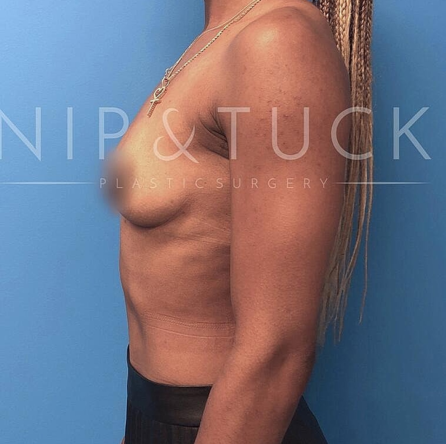 Breast Augmentation Before & After