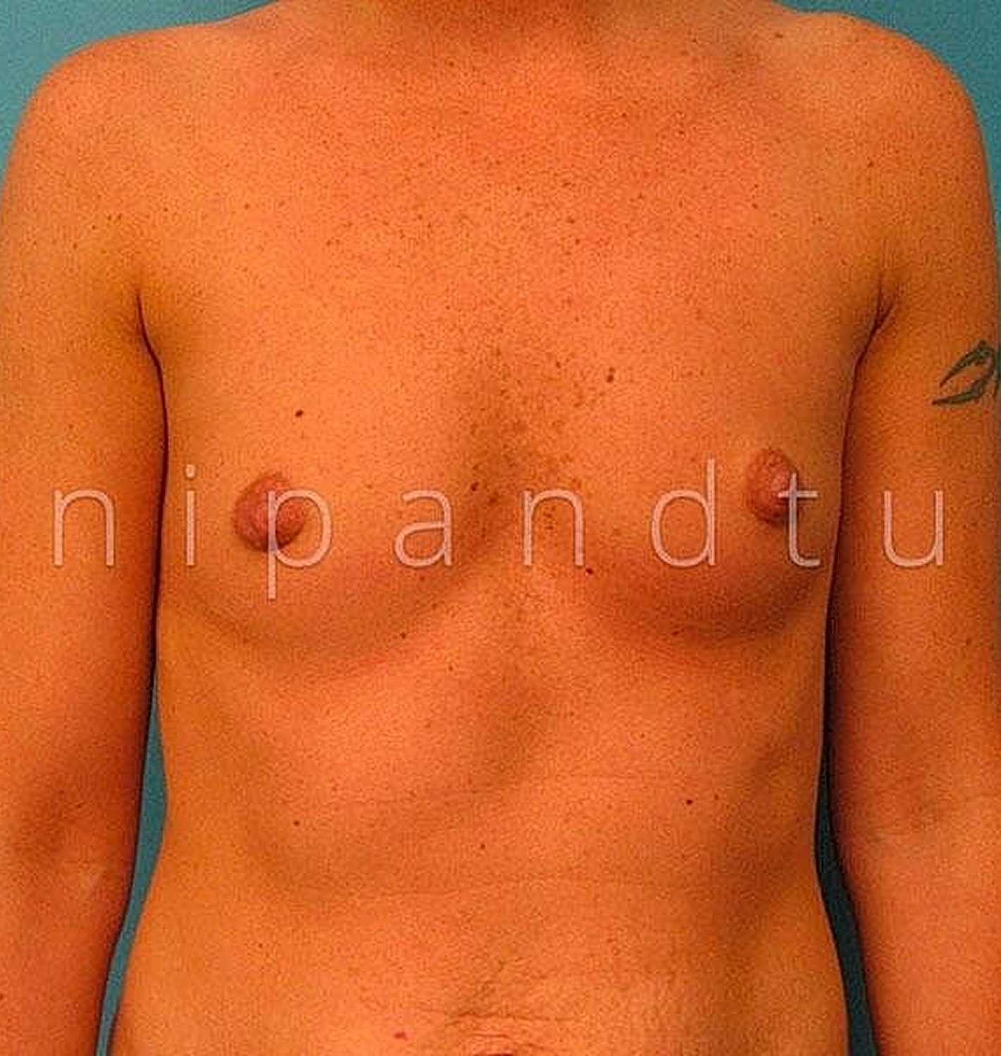 Breast Augmentation Before & After