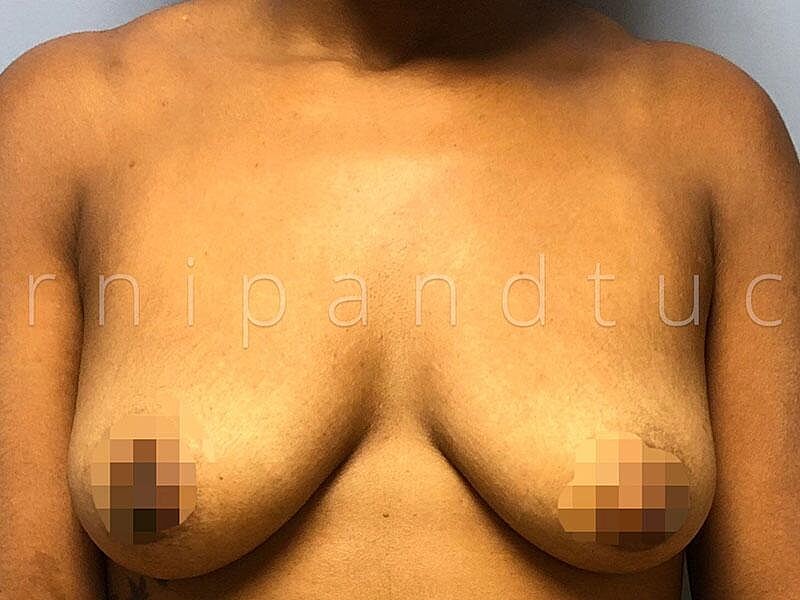 Breast Augmentation Before & After