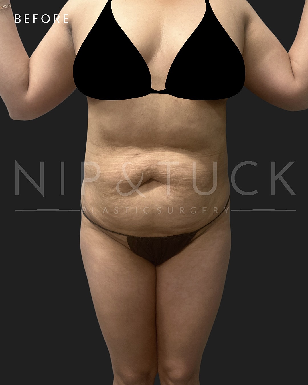 Lipo 360 Before & After