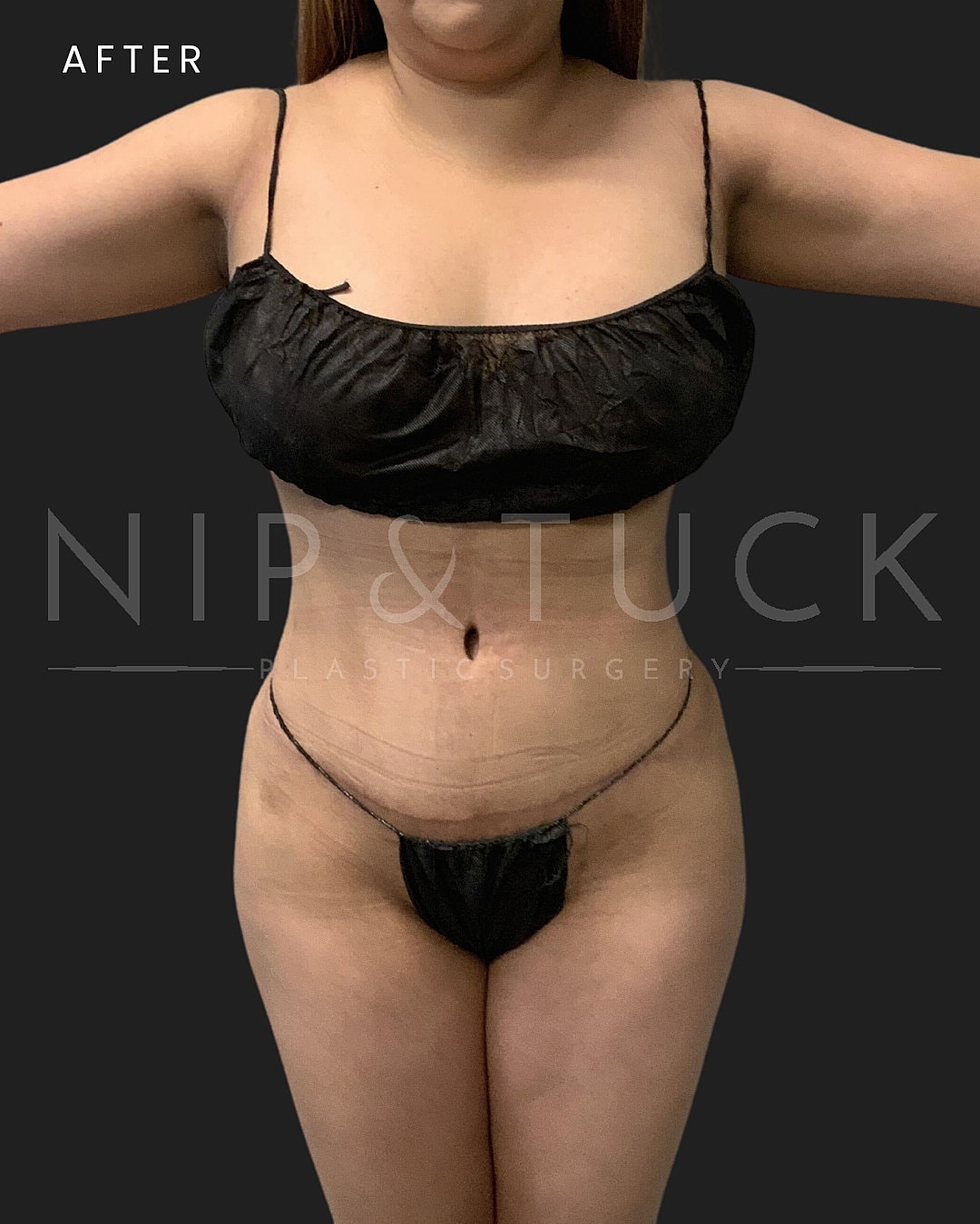 Lipo 360 Before & After