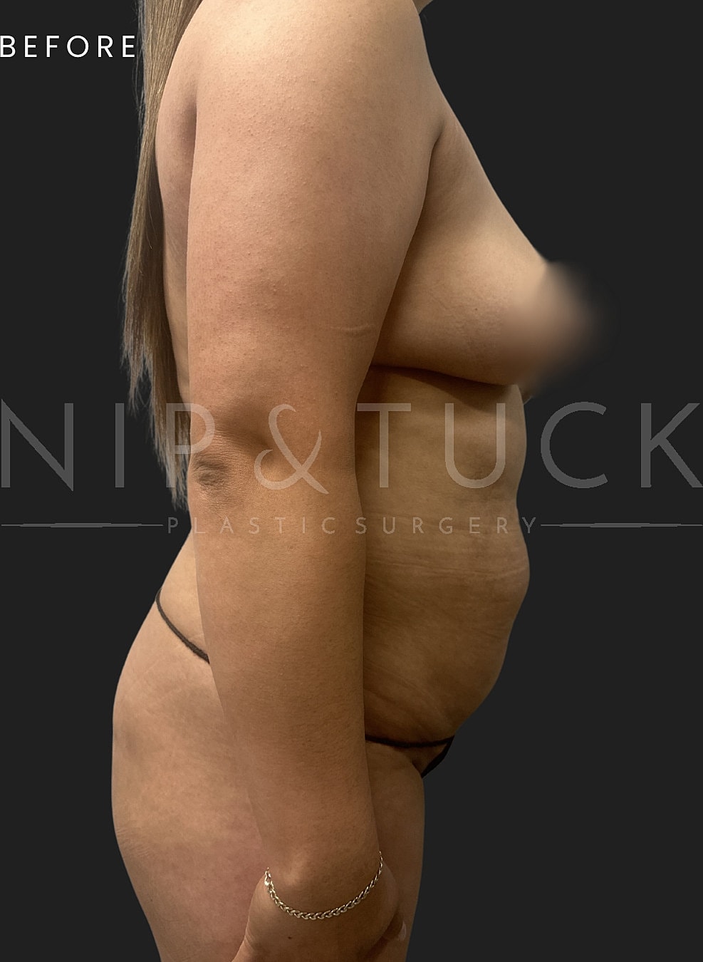 Lipo 360 Before & After