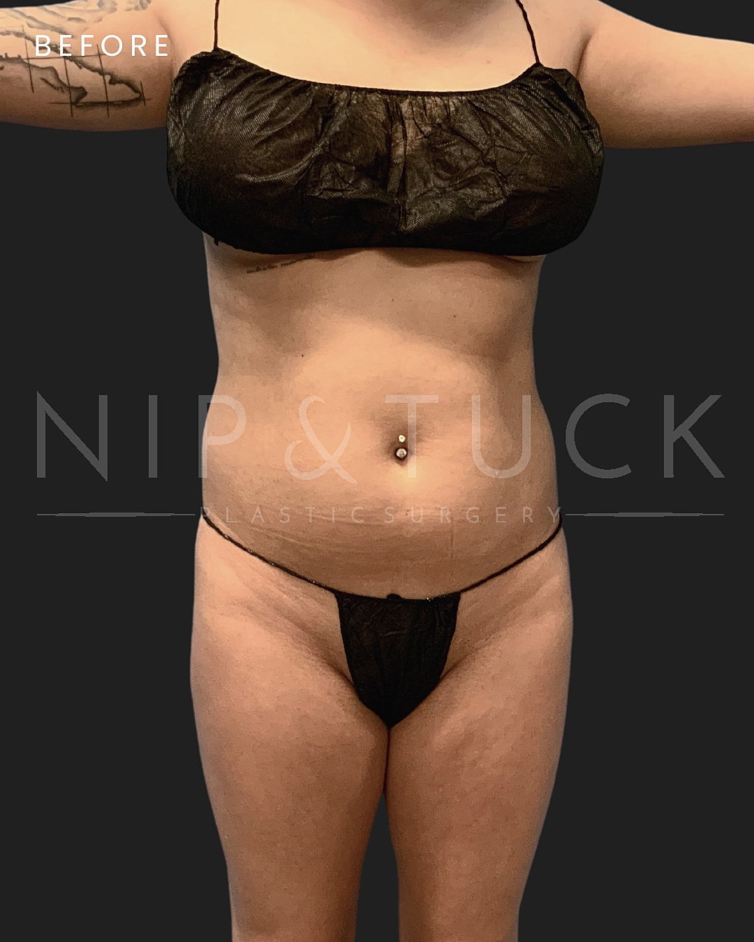 Lipo 360 Before & After